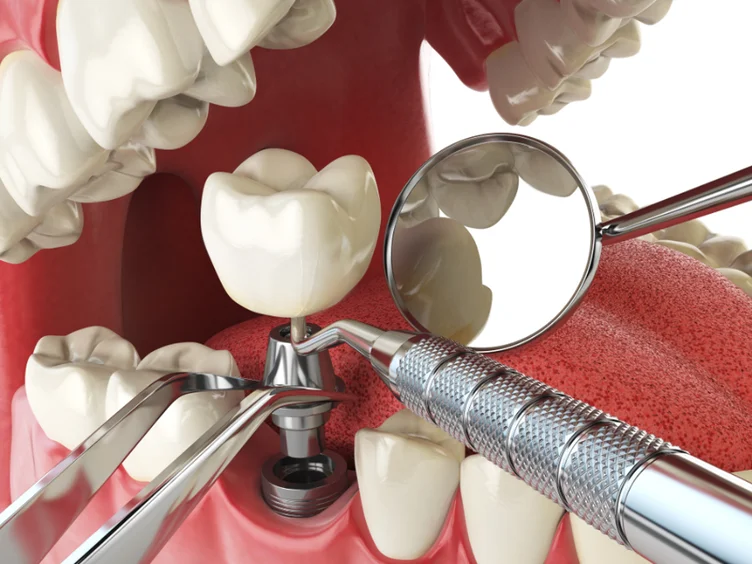 Close-up 3D illustration of dental implant placement showing crown attachment on titanium post.