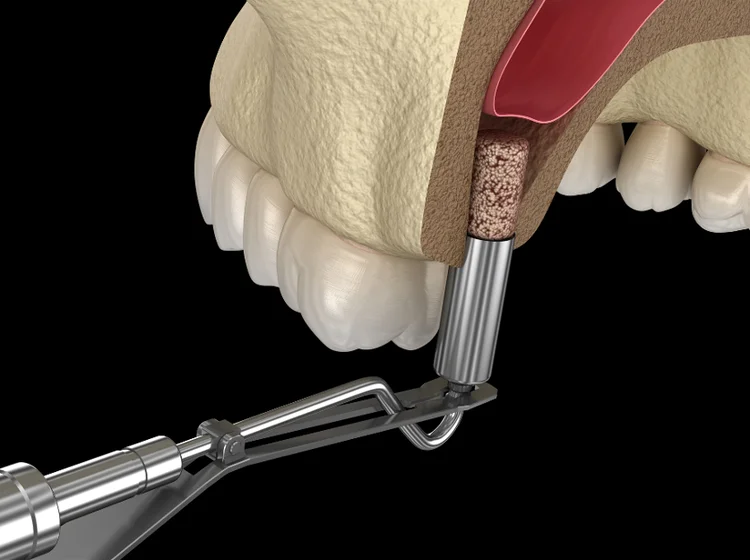 3D illustration of a sinus lift procedure showing the placement of bone graft material beneath the maxillary sinus membrane to increase bone height for dental implant support.