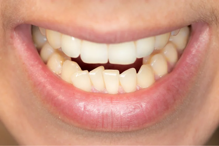 Asian man with crooked lower teeth contributing to the development of an underbite over time.