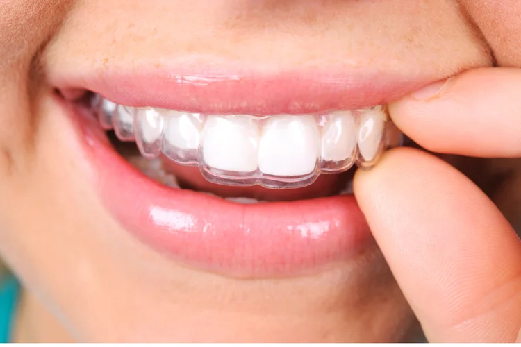Asian woman smiling while inserting clear retainer after orthodontic treatment to maintain alignment.