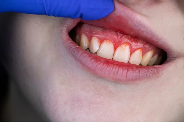Asian woman experiencing bleeding in gums due to gum disease (periodontal disease).