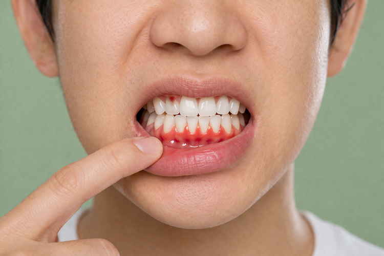 Person revealing bleeding and inflamed gums along the lower front teeth.