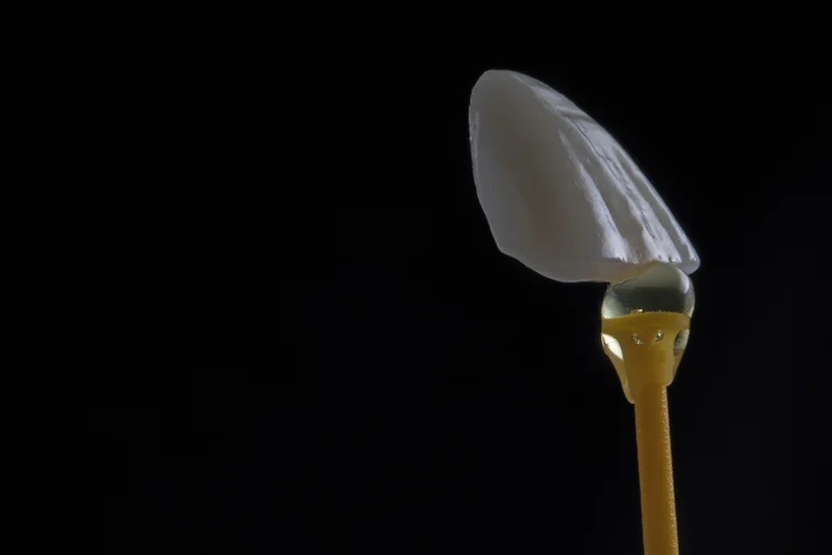 Close-up of a dental veneer, a thin custom-made shell usually crafted from porcelain or composite resin, covering only the front surface of the tooth.