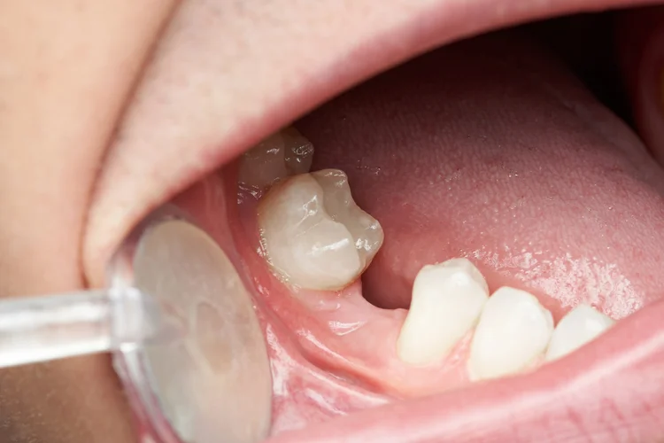 Close-up of a patient’s lower jaw showing a missing tooth space where a dental bone graft may be needed to prepare the jawbone for a future dental implant.
