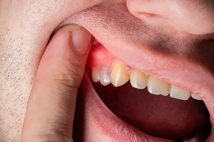 Close-up of receding gums showing an exposed tooth root due to gum tissue loss, a common symptom of gum recession and periodontal disease.