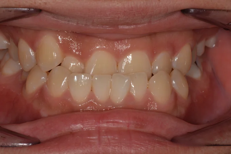 Close-up photo of a person with an underbite, affecting their ability to eat, speak, and maintain a positive self-image.