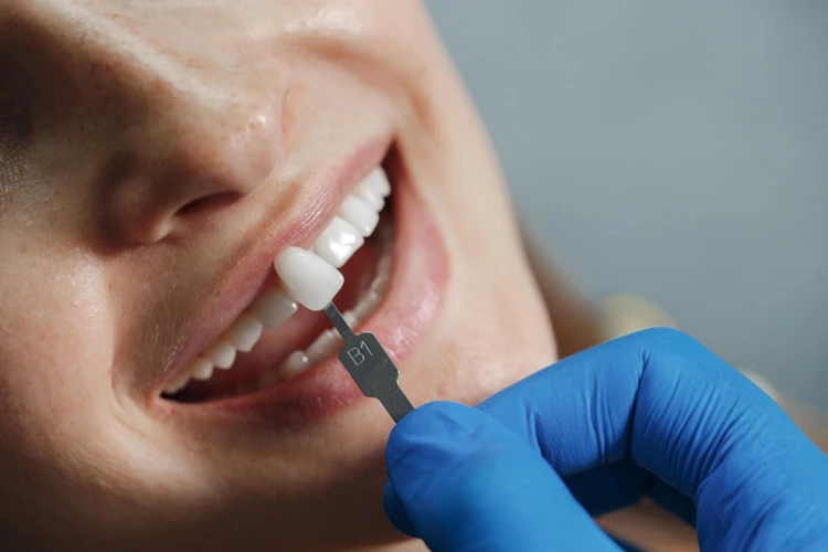 Close-up view of a dentist applying teeth veneers that seamlessly blend with a female patient’s surrounding teeth to enhance the overall aesthetic of her smile.