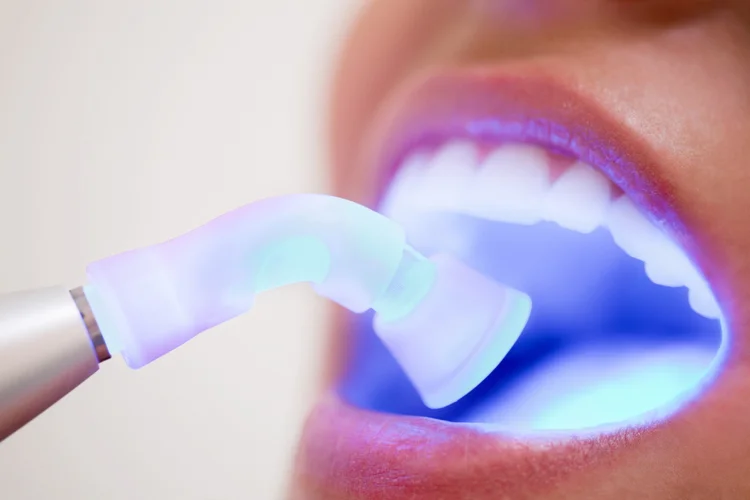 Dentist using curing light to harden composite resin during tooth bonding procedure.