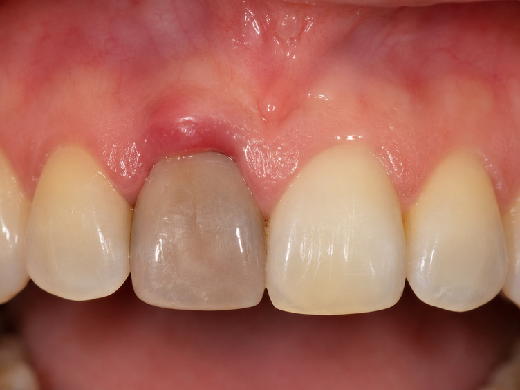 Darkened dead front tooth with a draining abscess on the gum above it.