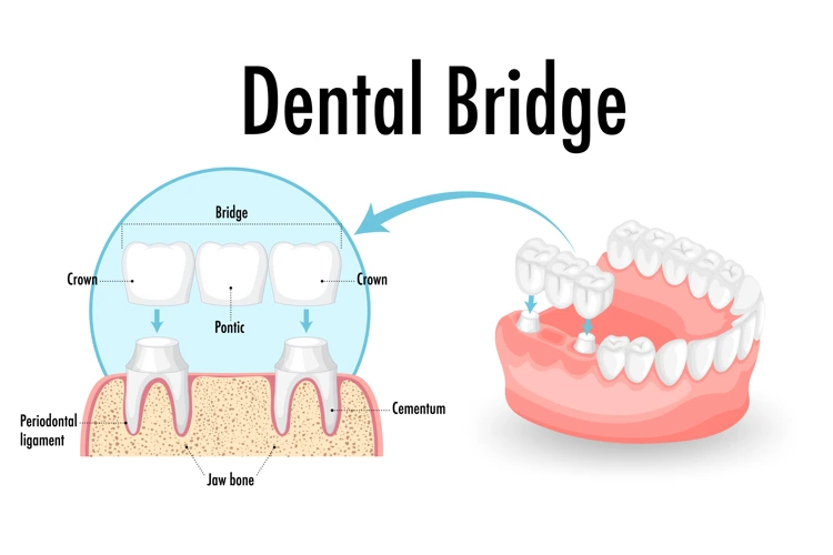 Diagram showing dental bridge components including crowns, pontic, and abutments.