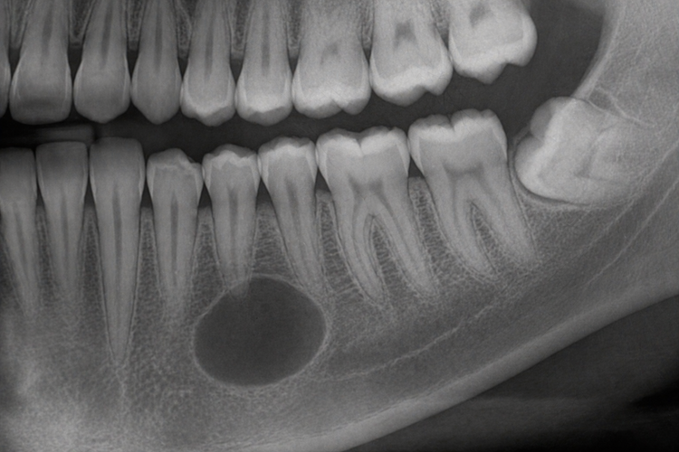 Dental X-ray showing a round cyst in the lower jawbone near the tooth roots.