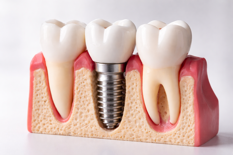 Cross-section model of a titanium dental implant placed in the jawbone.