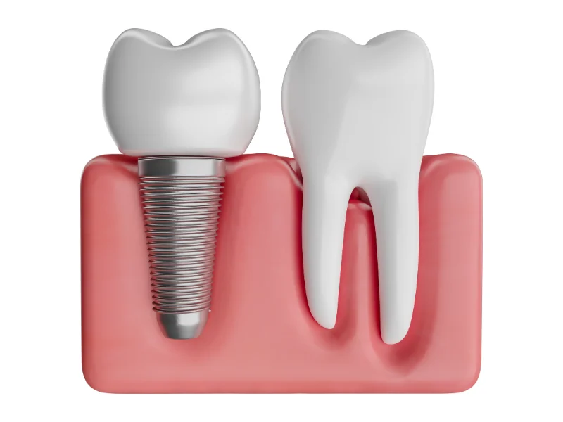 Dental implant with titanium post surgically placed into the jawbone to act as an artificial root, fusing with the bone over time to support a crown.