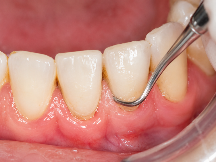 Scaling instrument cleaning along the lower gum line during gum treatment.