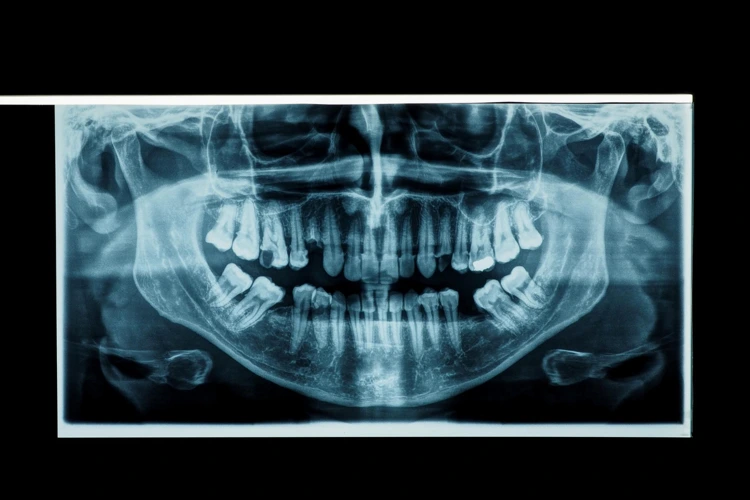Panoramic image of orthopantomogram (OPG) X-Ray of patient's teeth.