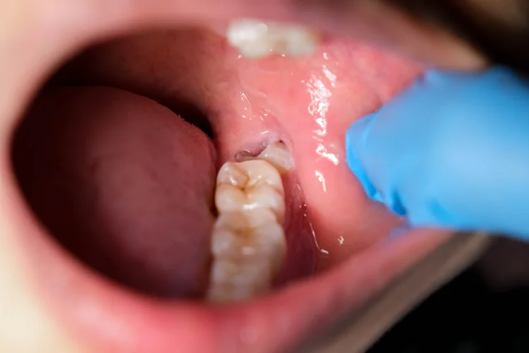 Dentist examining young man’s erupting wisdom tooth with pain and discomfort at the back of the mouth.