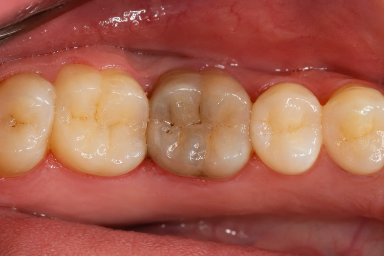 Discoloured grey molar showing the internal darkening typical of a dead tooth.