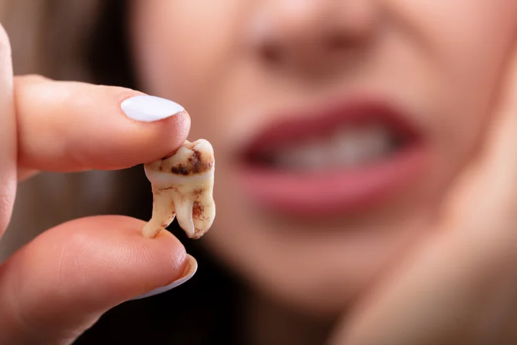Woman holding up extracted wisdom tooth with visible decay signifying common issues causing wisdom tooth pain and swelling.