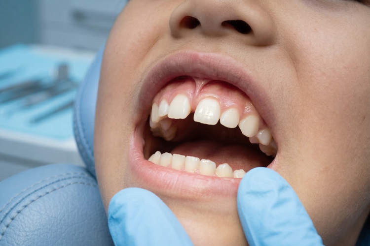 Dentist examining thick labial frenum causing gap between upper front teeth.