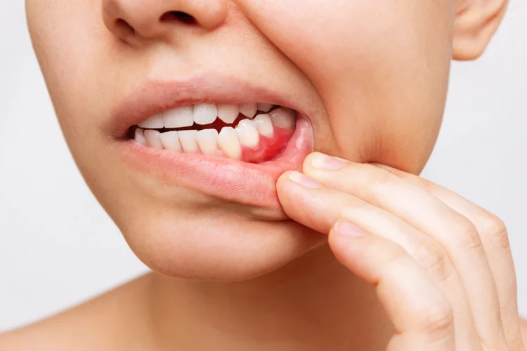 Gum inflammation visible as red, swollen, and bleeding gums while pulling the lip back, a key sign of gingivitis and potential gum recession.