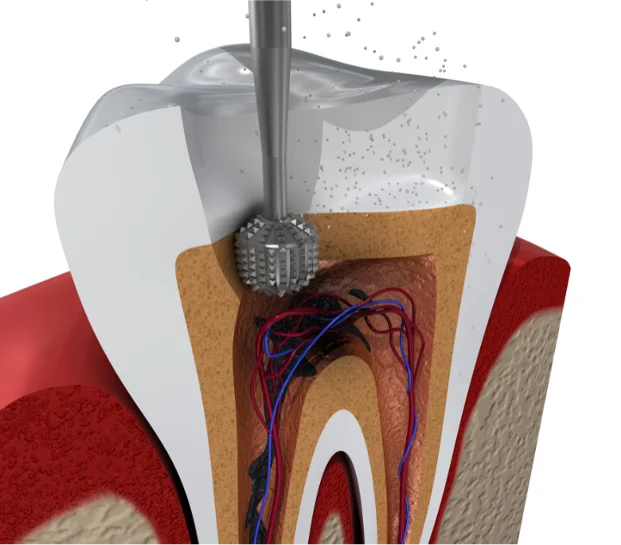 Illustration of dentist drill accessing pulp chamber during root canal procedure to remove infection.