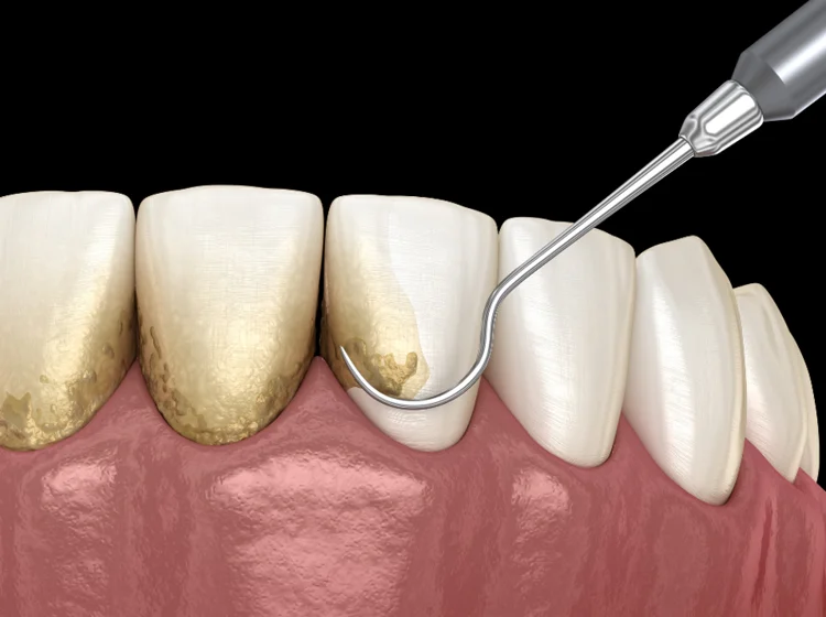 Illustration of teeth scaling by a dentist using a scaler to remove plaque and tartar from above (supragingival) the gum line.