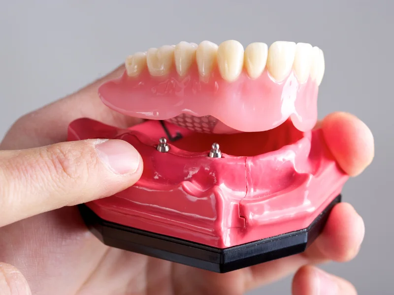Implant-supported dentures or bridges combine the stability of dental implants with the broader coverage of dentures or bridges, offering better stability, improved chewing ability, and helping to maintain jawbone health.