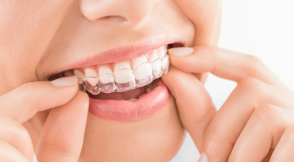 Invisalign aligners are removable for regular brushing and flossing, allowing you to maintain oral hygiene normally during the treatment process.
