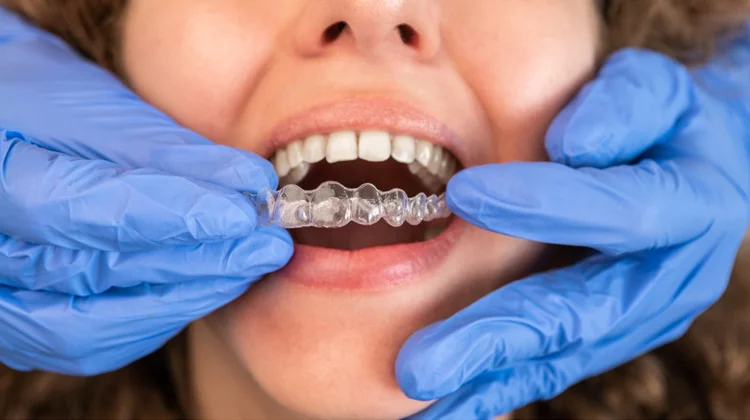 Invisalign involves in-person consultations and fittings with dentists and orthodontists, ensuring personalised adjustments and close supervision, especially for complex cases.
