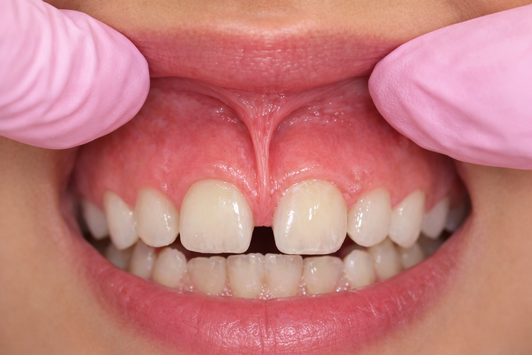Close-up showing labial frenum pulling gum and causing gap between front teeth.