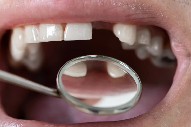 Man's mouth being examined by dentist for the most suitable and effective tooth replacement option.