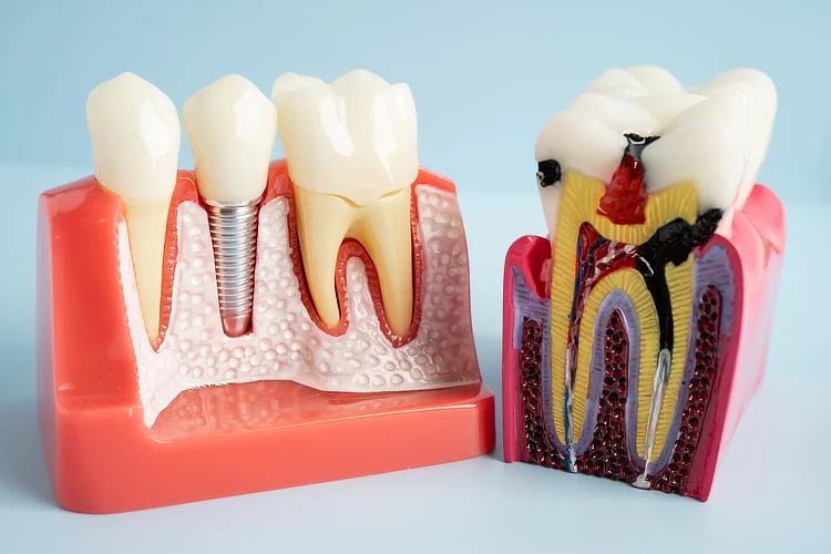 Models showing tooth implant beside decayed tooth showing extraction as root canal alternative.