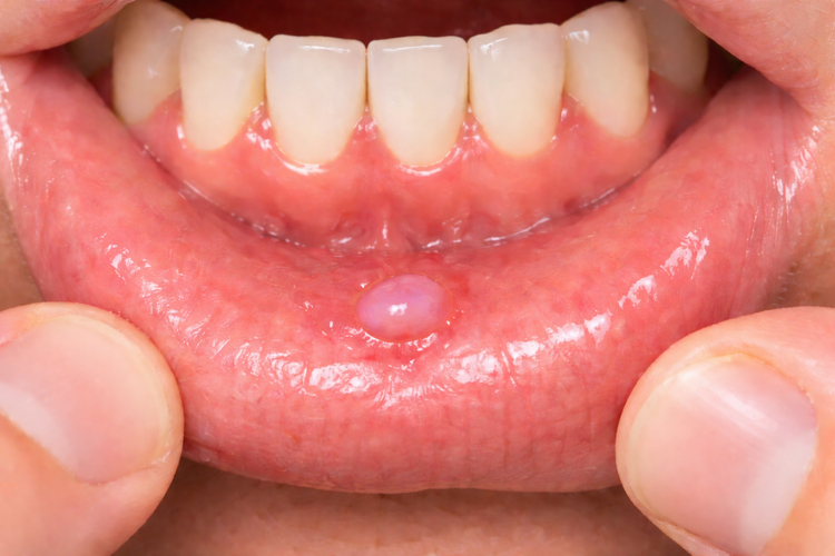 Clinical photo of a mucocele appearing as a soft lump on the inner lower lip.