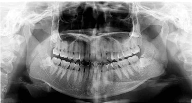Orthopantomogram (OPG) X-Ray image of patient's teeth.