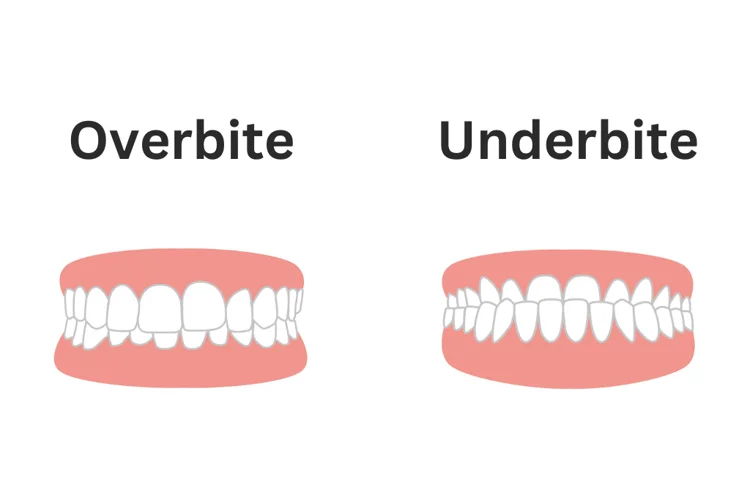 Overbite occurs when the upper front teeth overlap the lower front teeth, while underbite occurs when the lower front teeth protrude past the upper front teeth.