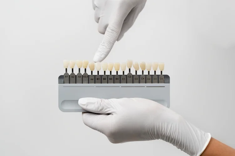 Porcelain veneers are more expensive than composite veneers due to their customised nature, natural translucent look, and excellent durability.