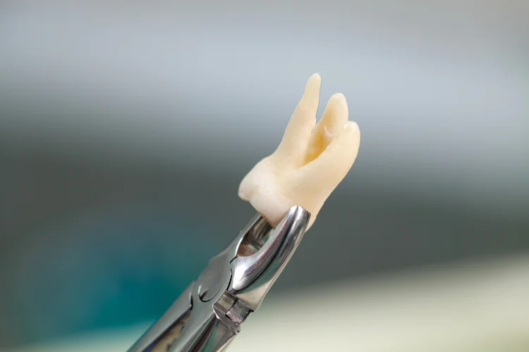Close-up of removed wisdom tooth in forceps showing simple extraction performed by dentist.