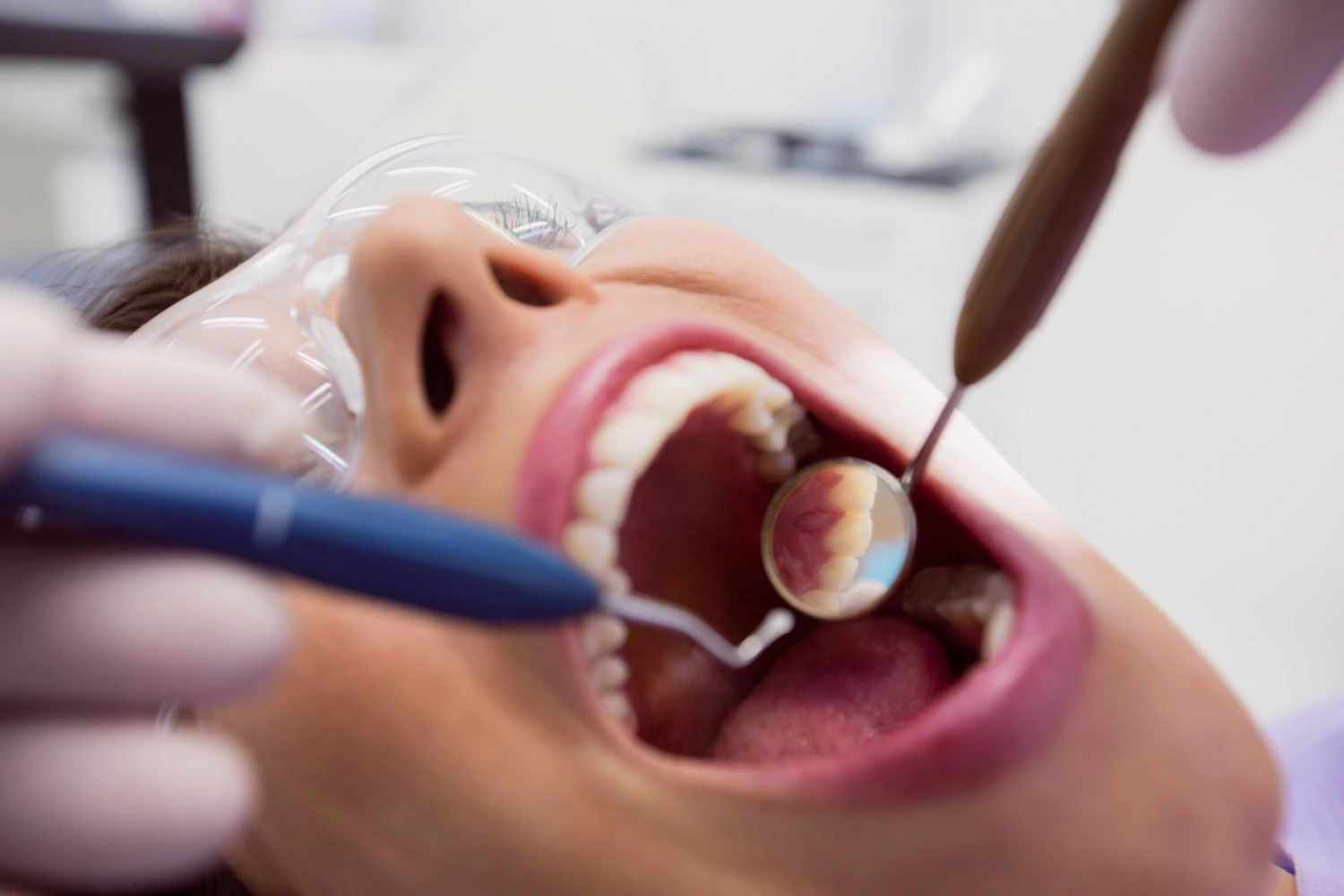 Before and after picture of a female patient's teeth after undergoing teeth whitening procedure.