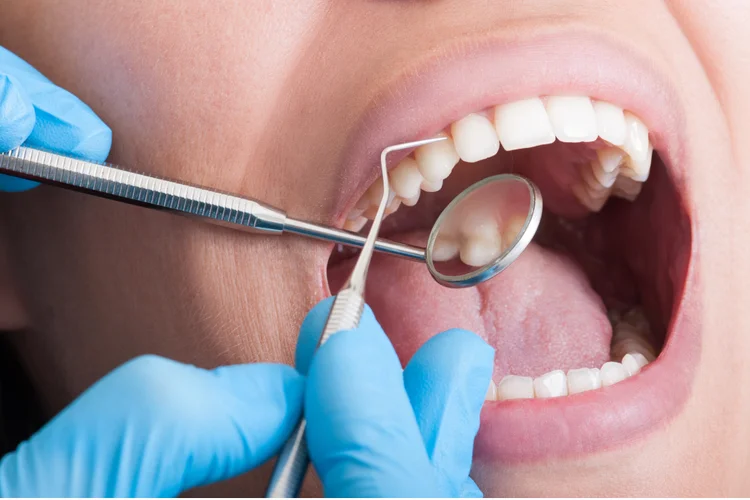 Dentist scaling and polishing teeth before fluoride treatment to improve gel absorption.