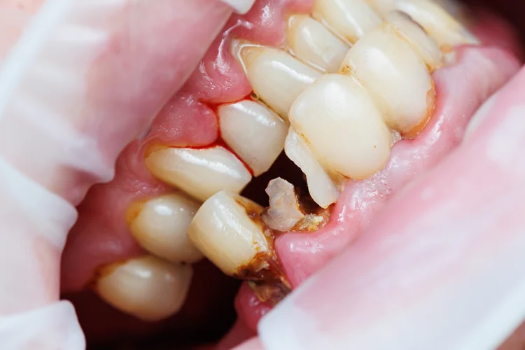 Close-up of severe untreated gum disease with complications such as tooth decay, receding gums, exposed roots, and bone loss.