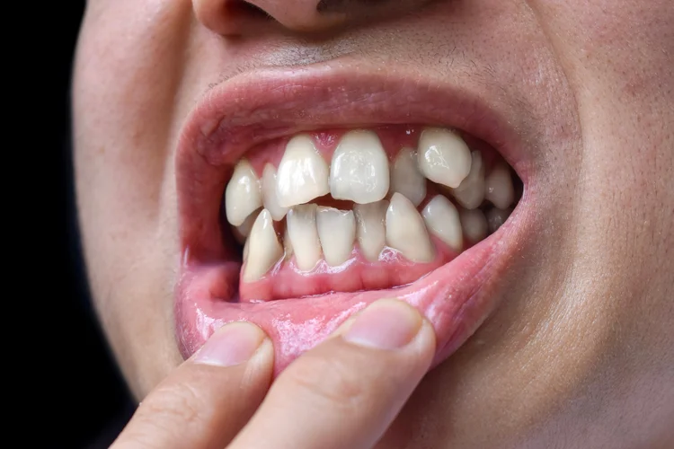 Close-up of severely crowded teeth in upper and lower jaw showing visible misalignment.