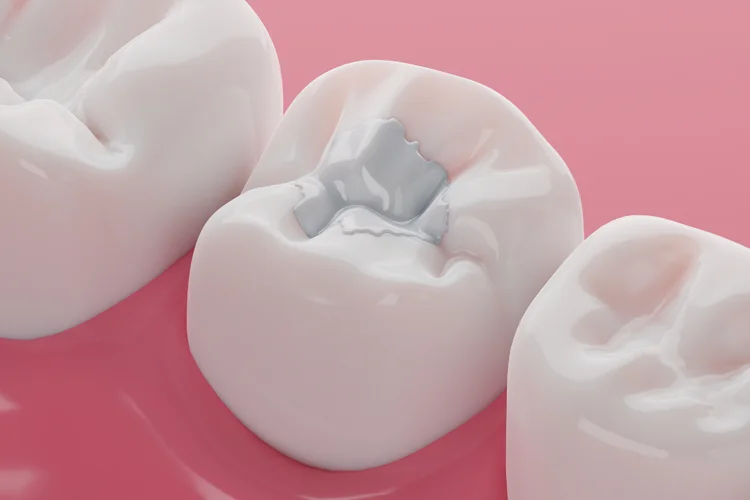 Close-up of molar with silver composite filling used for cavity repair on gum background.