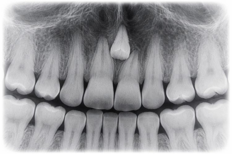Dental X-ray showing a supernumerary tooth between the upper front teeth.