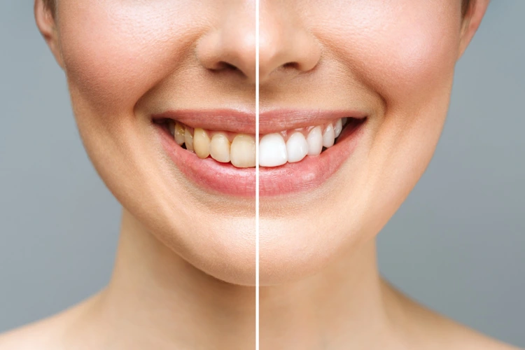 Before and after picture of a female patient's teeth after undergoing teeth whitening procedure.