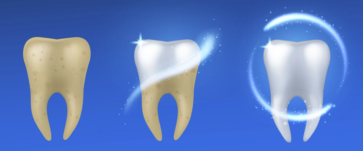 Illustration of the stages of yellow teeth undergoing teeth whitening treatment to become white and shiny in appearance.