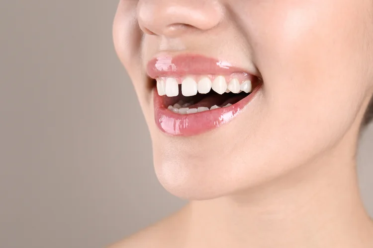 Woman smiling with front tooth gap before dental bonding for cosmetic correction.