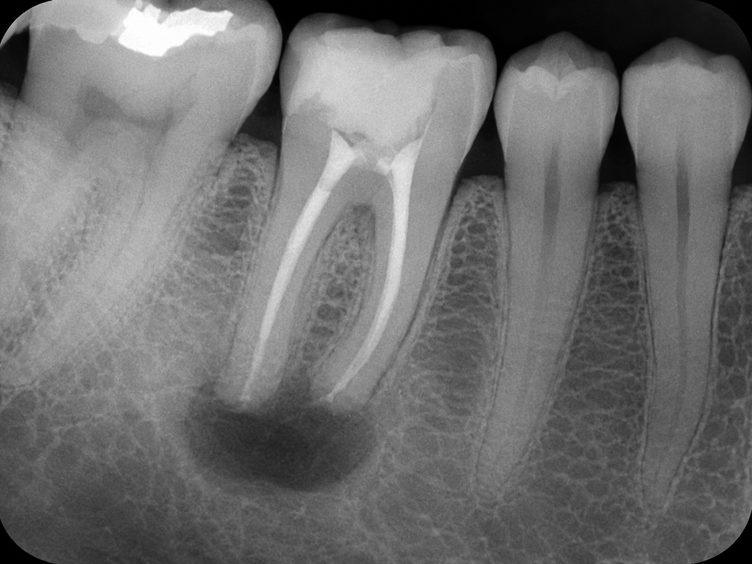 Dental X-ray showing a dead tooth with dark infection around the root tip.