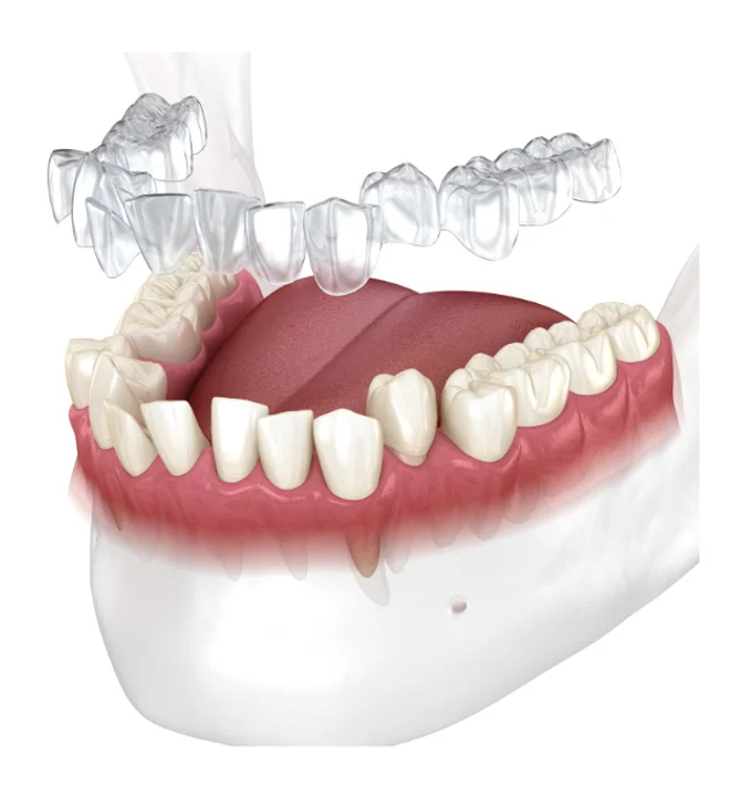 Treatment complexity: Invisalign is effective for both simple and complex cases, while Zenyum is best suited for mild to moderate cases.