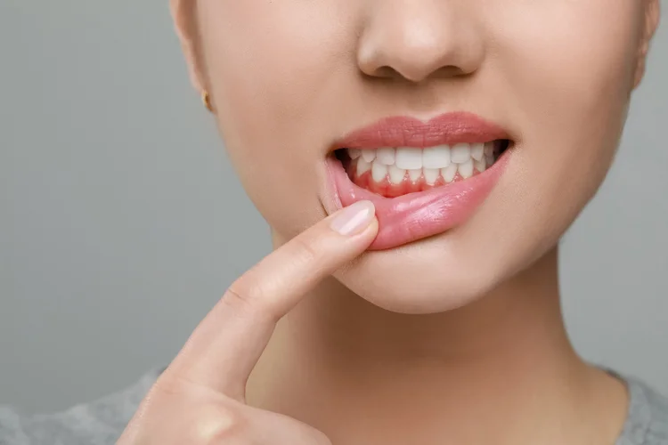 Woman pointing to inflamed gums showing signs of gum disease caused by plaque buildup, poor oral hygiene, or hormonal changes.