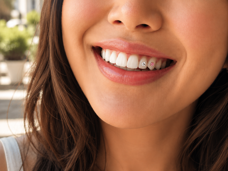 Close-up of a woman smiling with two tooth gems bonded to her upper front teeth.